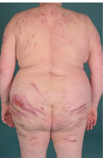 Figure 1 Patient with representative linear prurigo lesions.