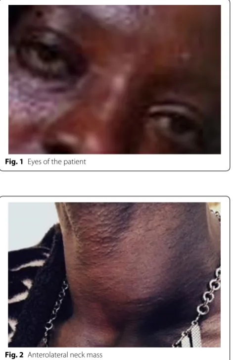 Fig. 2 Anterolateral neck mass
