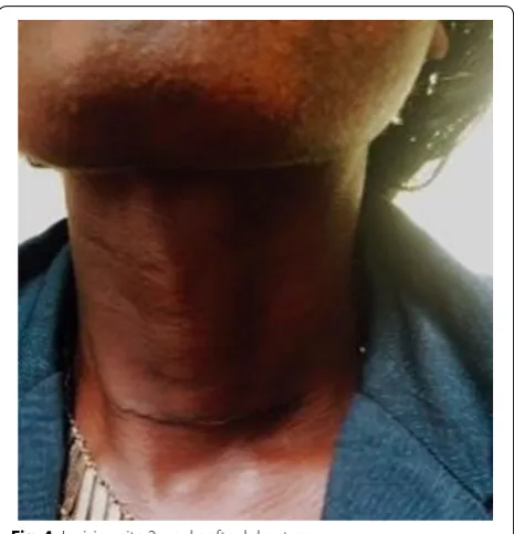 Fig. 4 Incision site 2 weeks after lobectomy