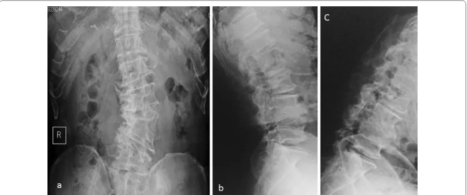 Fig. 1 a Anteroposterior-view plain X-ray scan of the lumbar spine showing scoliosis accompanied by degenerative changes and two assimilation vertebrae, one of which comprised the right L4 hemivertebra and L5 vertebra and the other comprised the left L4 he