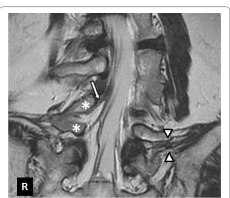 Fig. 2 Computed tomographic scan of sagittal section followed by myelography showing no stenosis in the central spinal canal