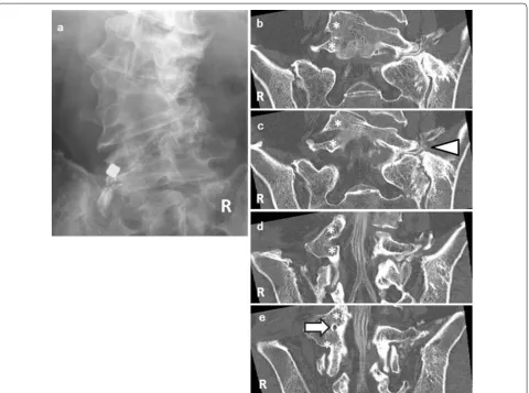 Fig. 4 a Selective radiculography of the left L5 spinal nerve. b–e Computed tomographic scans of the coronal section