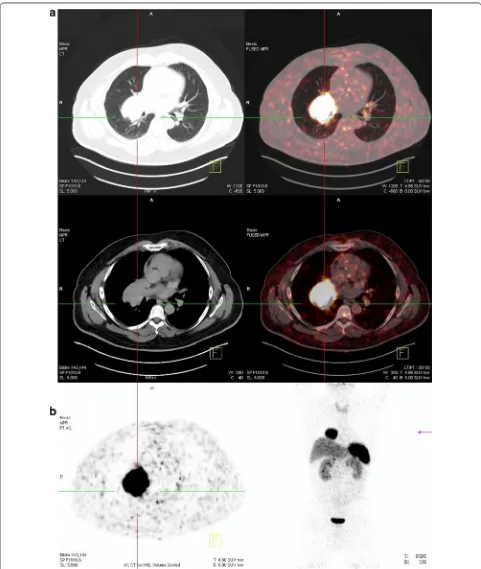 Fig. 2 68Gallium-DOTATOC PET-CT before surgery revealed a large tumor mass located in the right lung with high somatostatin receptor expression