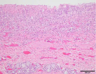 Fig 1. Histopathologic appearance of the esophagus of dog 3, 100 9 magniﬁcation. The esophageal stratiﬁed squamous  epithe-lium is nearly completely absent and replaced by a thick tract of loose ﬁbrosis and granulation tissue with admixed ﬁbrin and necroti