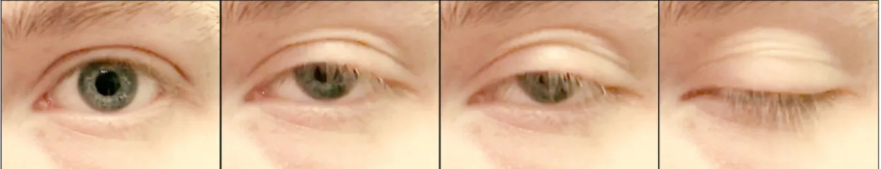 Fig. 3 When participants blink, the pupil will momentarily be partly occluded. With some eyetracking systems, this may result in erroneous dips in pupil size (the edge artifacts shown in Fig