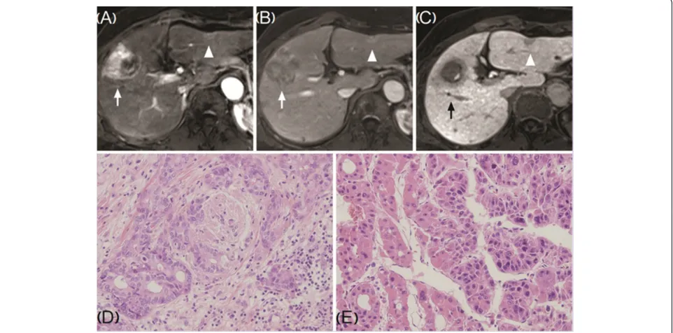Figure 2 Dynamic magnetic resonance imaging (MRI) of the liver (A-C, T1-weighted spoiled gradient echo image), and histology ofwell-differentiated cholangiocarcinoma.surgical specimens (D-E)