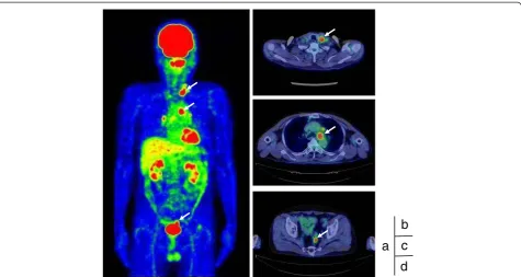 Figure 3 Microscopic findings of resected mediastinal lymph nodes and the rectal tumor