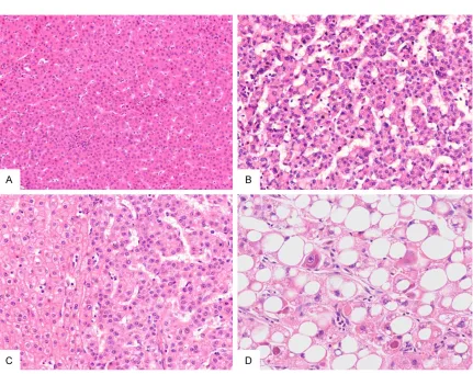 Table 3. Comparison of vaguely nodular type and distinctly nodular type in small hepatocellular carci-noma