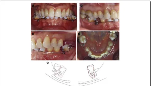 Fig. 10 Uprighting of a mesially tipped #37 with miniscrew implants, a modified removable appliance with an uprighting spring, and anelastomeric power chain