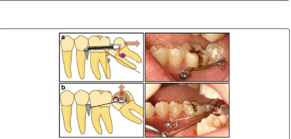 Fig. 4 Preprosthetic uprighting of #37 with a miniscrew implant and an uprighting spring.eccentric V-bend.spring