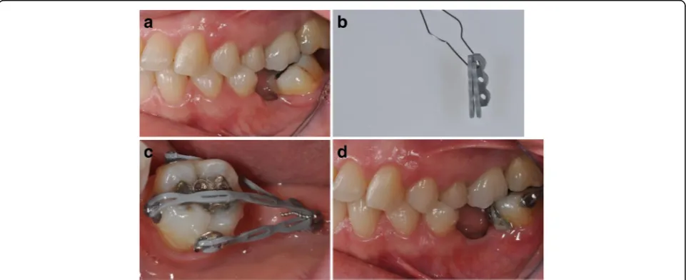 Fig. 6 Uprighting of an impacted #37 with miniscrew implant and a closed coil spring tied to an orthodontic bracket.inserted in the retromolar area and loaded with 50-g force on nickel-titanium closed coil spring