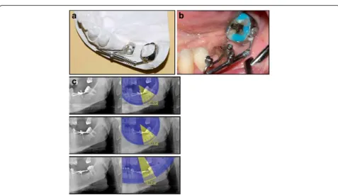 Fig. 9 Uprighting #27 and #37 with miniscrew implants, elastomeric threads, and a temporary bite plane.cuprighting with mini implants