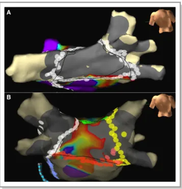 Figure 1 shows endocardial voltage maps for a patient with electrical silence of the PW (Figure 1A) (de ﬁned as no measured voltage >0.1 mV) after endocardial-only ablation and a patient for whom silence of the PW could not be achieved despite exhaustiv