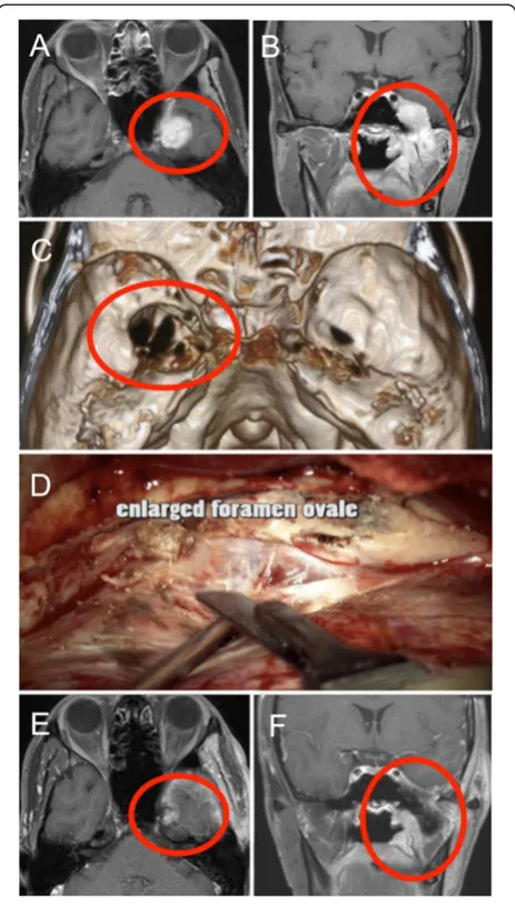 Figure 1 Pre-, Intra-, and Post-operative findings of the presentcase. A and B, Gadolinium-enhanced T1-weighted magnetic resonanceimages revealing a mass in the infra-temporal and middle cranial fossa(circle)