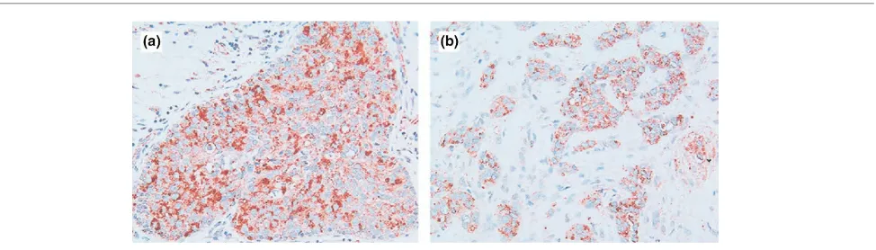 Figure 2COX-2 expression in human breast tumors. Cyclooxygenase (COX)-2 protein has been detected in human breast biopsies in both (a) ductalcarcinoma in situ and (b) infiltrating mammary carcinoma using immunohistochemistry on formalin-fixed tissue sectio