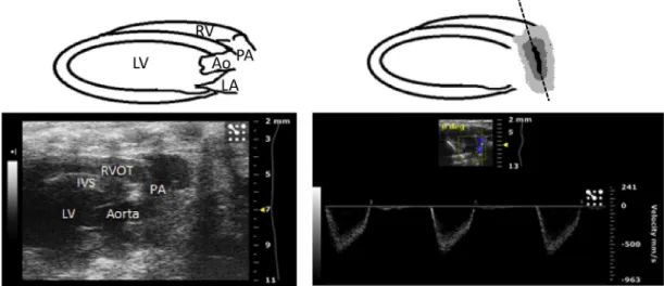 Fig. 6 e Color Doppler image of flow through the pulmonary artery (PA), used to calculate pulmonary arterial acceleration time (PAT), measured as the time elapsed between the beginning of the waveform to the point of PA peak velocity, PA velocity time inte