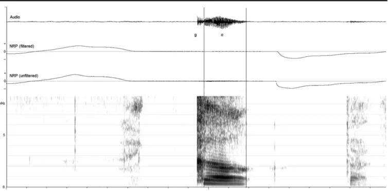 Figure 1. Example of audio, filtered nasal ram pressure (NRP), unfiltered NRP, and spectrogram of /go/ produced by a typically developing child without cleft palate at 18 months of age