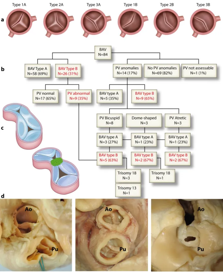 Fig. 1    a Schematic overview of different BAV morphologies (Modi- (Modi-fied after [13])