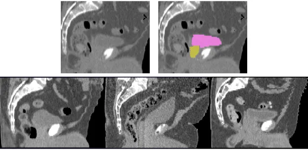 Figure 1.2: Sagittal male pelvis slices in CT. Top: Original greyscale image on the left, with bladder (pink) and prostate (gold) highlighted on the right