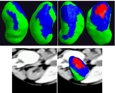 Figure 3.6: Top: kidneys colored according to the profile type selected at each point, using the same color scheme as before (see Figure 3.4)