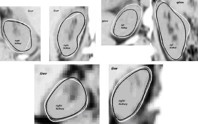 Figure 3.7: Example segmentation results on three axial/coronal slice pairs. The dark contour is the result of the Gaussian derivative template, while the lighter contour comes from the clustered template.