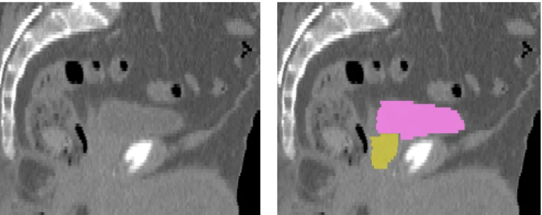 Figure 4.1: Example sagittal CT slice of the male pelvis (left), with the bladder and prostate highlighted (right)