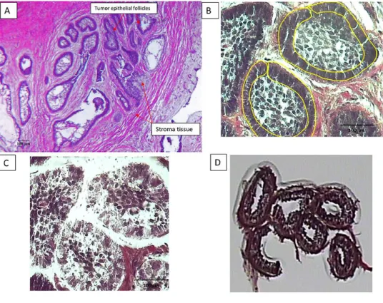 Figure 3.1: The micrographs show the laser capture of the epithelial portion of an 