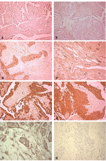 Figure 6: Expression of IL-8 receptors RA and RB in ovarian high grade serous carcinoma