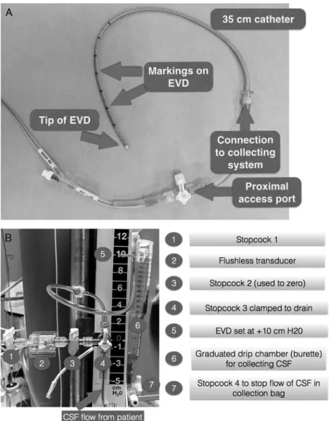 FIGURE 2. A, Components of an EVD (a representative example of antimicrobial-impregnated EVD)