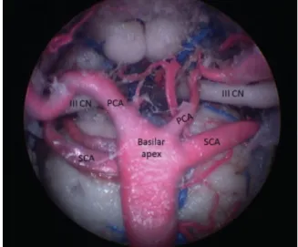 Fig. 1 Endoscopic view obtained in a cadaver showing basilar apex.