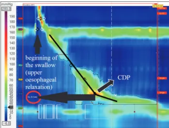Figure 3.  Distal latency (DL) measures objectively the time frame of  the wave from the beginning of the swallow (upper esophageal  relax-ation) to the contractile deceleration point (CDP).