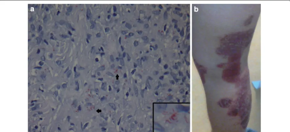 Fig. 1 a 22-year-old Filipino woman with leprosy initially suspected for sarcoidosis. The patient was designated as a case of BT/BB with a type 1 reaction (a)