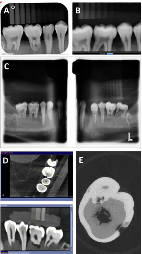 Fig. 2. Representative images of extracted teeth and caries for PSP (A), Schick 33 (B), Planmeca  panoramic bitewing (C), Sirona Orthophos XG3D CBCT (D), and micro-CT ground truth (D)
