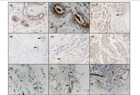 Figure 6MUC4 expression in human breast tissueMUC4 expression in human breast tissue. Tissue microarrays were analyzed by immunohistochemistry using 1G8s
