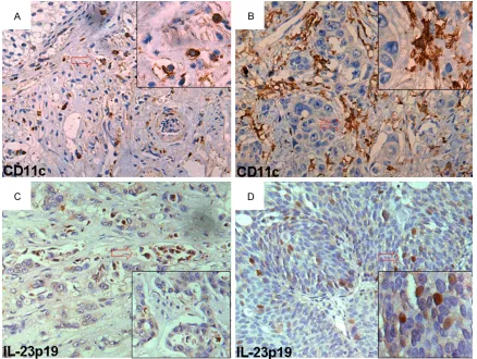 Figure 1. Distribution of CD11c+ mDCs and IL-23p19 in NMI- and MI-TCCs. CD11c+ mDCs were observed in the stroma and within tumors (A, B)
