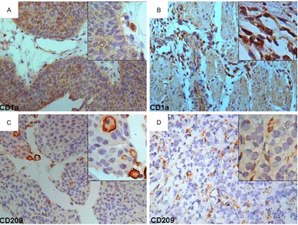 Figure 3. Distribution of CD1a+ and CD209+ immature DCs in NMI- and MI-TCCs. CD1a+ DCs were found mostly in the epithelium of the control (data not shown)