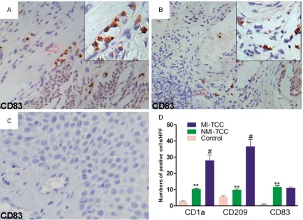 Figure 4. Distribution of CD83+ matures DCs in NMI-, MI-TCCs and controls. CD83+ mature DCs were distributed in the underlying stroma, rarely within tumors and frequently in lymphoid aggregates (A, B), but there were virtually no CD83+ mature DCs in contro