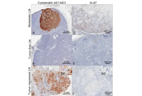 Figure 2 Immunohistochemical validation of the tumor‐regressed lymph node. (A‐C) Cytokeratin AE1/AE3 immunostaining