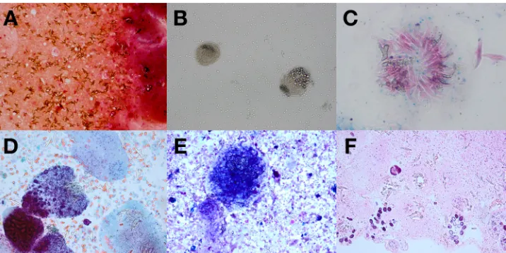 FIG 1 (A) Gram stain of cyst ﬂuid (magniﬁcation, �200). (B) Wet-mount preparation of cyst ﬂuid (magniﬁcation, �200)