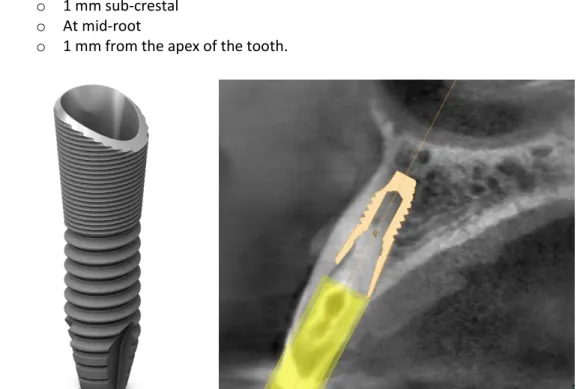 Figure 2.1.  Image of 4.5 mm diameter OsseoSpeed Profile implant (left).  Representative example of  implant positioning for immediate placement in a #7 site (right)