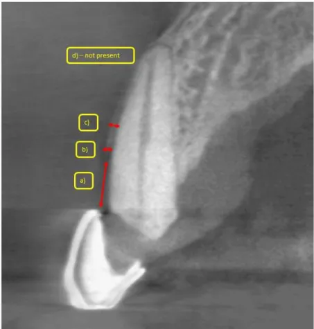 Figure 2.2.  Representative two-dimensional slice through the surgical site showing reference  measurements and measurements of a) facial CEJ to the most coronal point of the facial bone crest,  b) facial plate 1 mm subcrestal, c) facial plate at mid-root,