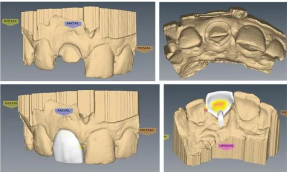 Figure 2.3.  Screenshots displaying scanned cast with arbitrary preparation (top) and planned  bonded pontic provisional with small palatal “wings” (bottom)