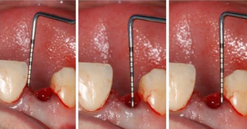 Figure 2.5.  Using a periodontal probe to evaluate facial bone in relation to soft tissue margin