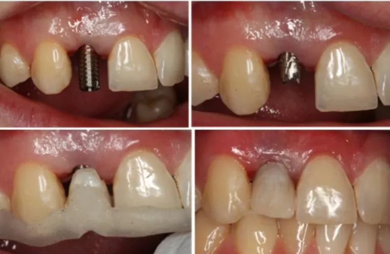 Figure 2.6.  Temporary abutment before and after modification (top).  Using jig to position pontic  and checking final contours before polishing (bottom)