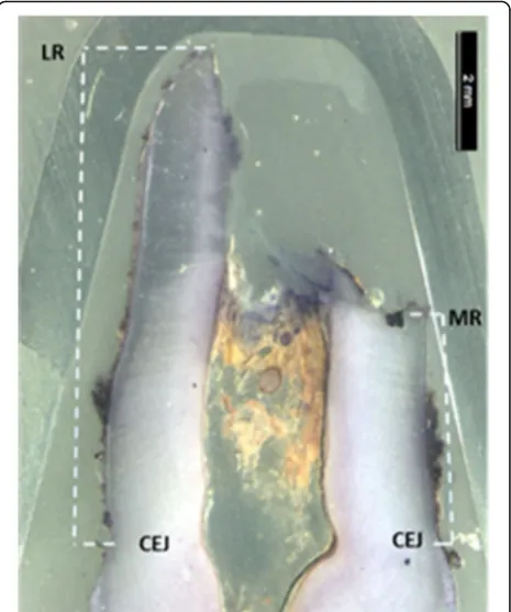 Fig. 2 Microscopic image of an extracted deciduous canine showingslanted root resorption and how the root length measurements fromcemento-enamel junction (CEJ) to the most resorbed (MR) side andfrom CEJ to the less resorbed (LR) root side were measured