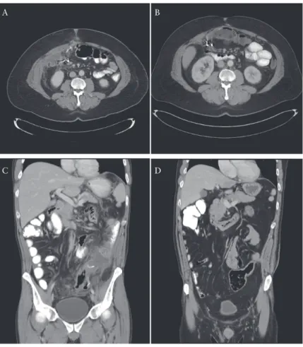 Figure 2 shows fluoroscopic images from a sonogram showing an  unresolved fluid pocket and the resolved drain endpoint.