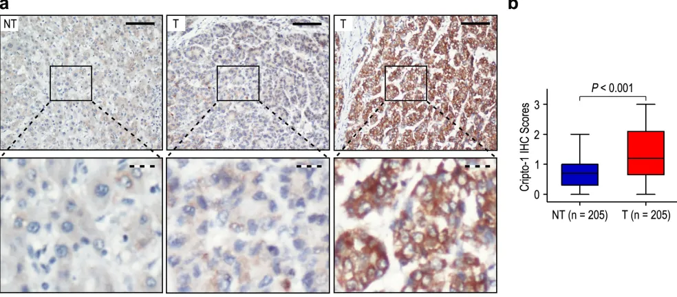 Figure 1: Cripto-1 was significantly up-regulated in hepatocellular carcinoma (HCC). a