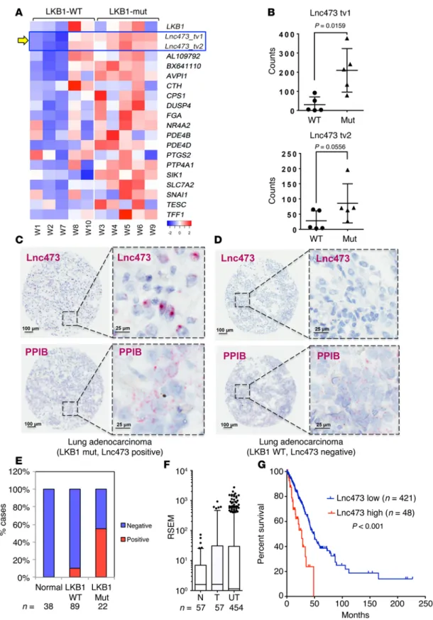 Figure 2. Enhanced LINC00473 expression is highly correlated with human lung adenocarcinoma with LKB1 mutational status and is associated with poor  survival
