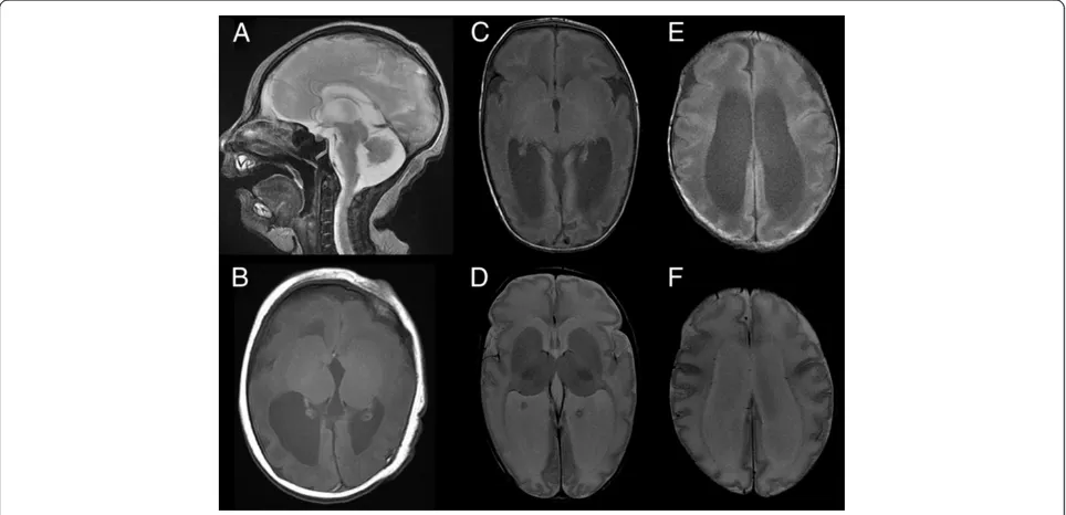 Figure 1 Brain magnetic resonance imaging of the patient. T2-weighted sagittal (A) and T1-weighted axial (B) images at 6 days after birthindicate hypoplastic vermis of the cerebellum, cortical dysgenesis with a simplified gyral pattern, and dilatation of t