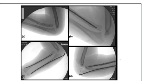 Figure 2 Subsequent further imaging in plaster demonstrating an anterior dislocation of the radiocapitellar joint.